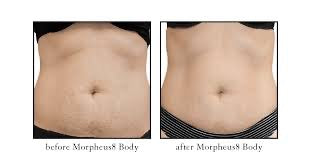 Morpheus8 Body
